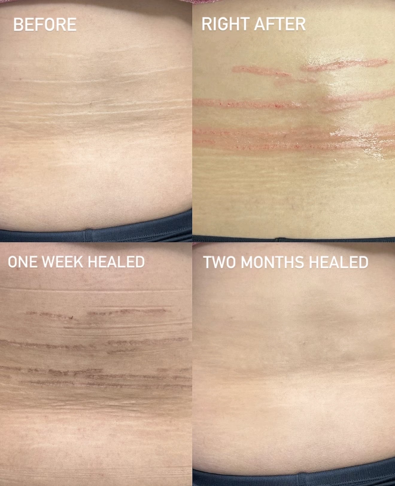 Stretch mark healing journey
