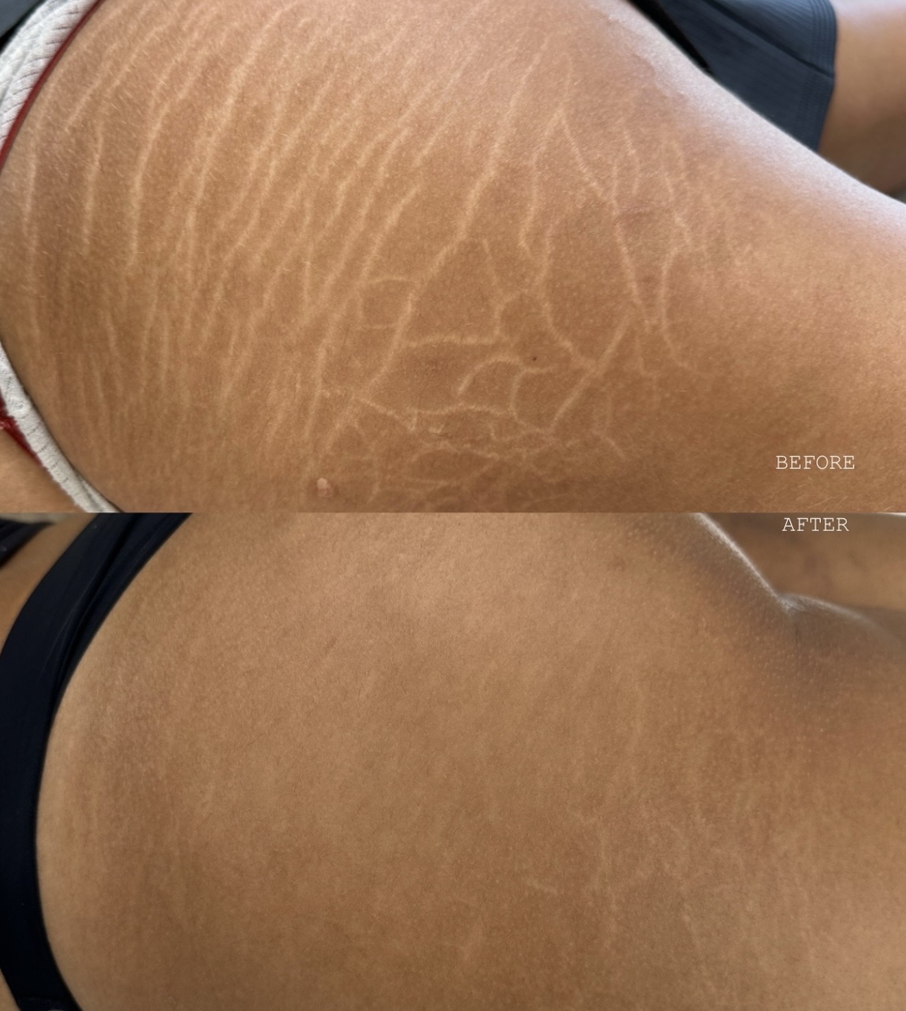 Stretch mark comparison